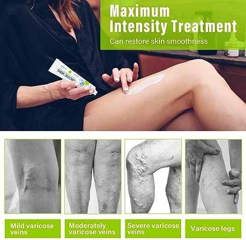 MOSKILA Varicose Veins Treatment for Legs, 2 Count Nature Varicose Veins Cream, Effective Varicose Veins Treatment for Varicose & Spider Veins, Relieve Leg Swelling & Fatigue Relief, 0.7oz